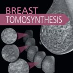 Breast Tomosynthesis - 2017