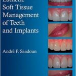 Esthetic Soft Tissue Management of Teeth and Implants - 2013