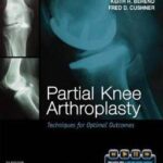 Partial Knee Arthroplasty: Techniques for Optimal Outcomes - 2012